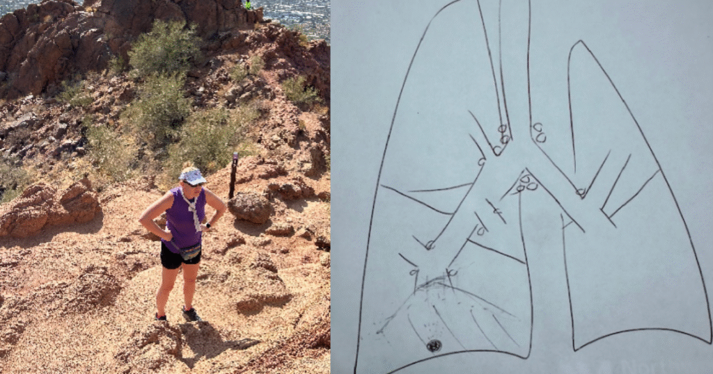 How a broken limb led to a non-smoker’s lung cancer diagnosis a decade later